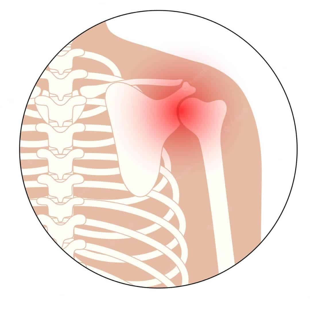 Shoulder Arthritis