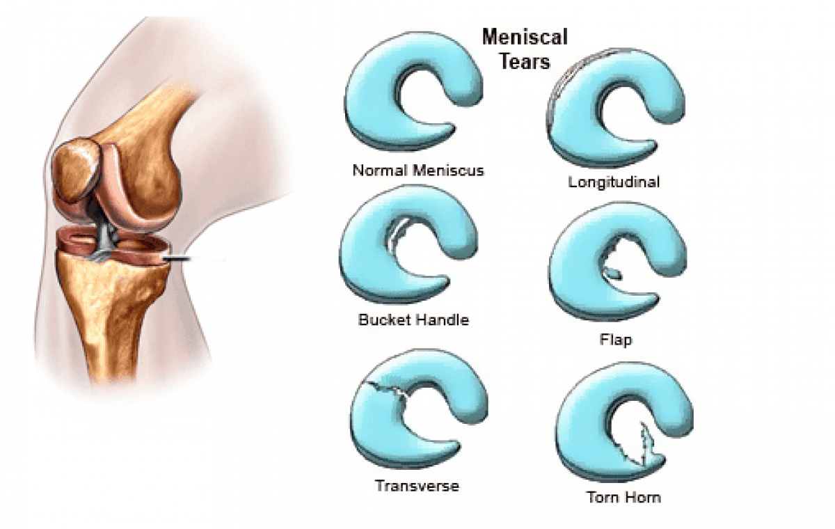 Why You Shouldn't Leave a Meniscus Tear Untreated I Saqsham Ortho